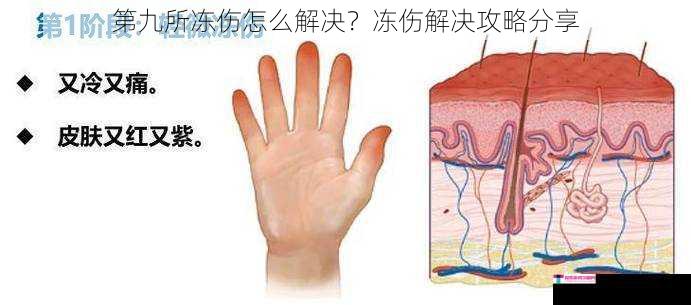 第九所冻伤怎么解决？冻伤解决攻略分享